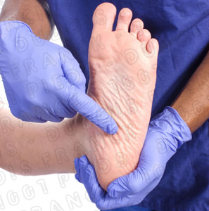 Verrue plantaire 1001pieds ™