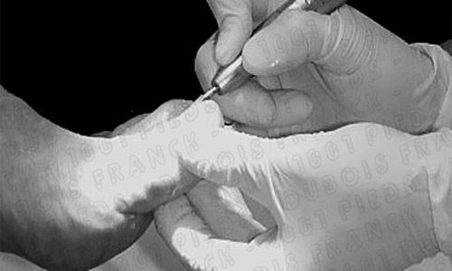 reconstruction de l'ongle en gel UV par 1001pieds ™