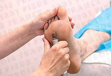 1001pieds ™ durillon, callosité, cors, corne, oeil de perdrix