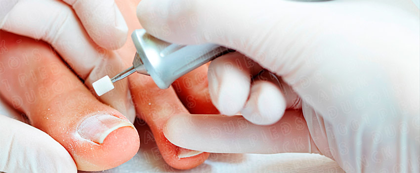 mycose champignon soin pedicure podologue