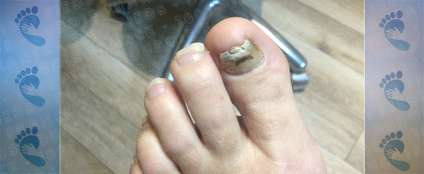 gel UV Gewhol, reconstrucion ongle abimé, jaunis