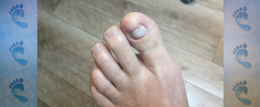 Assainir et nettoyer avant la reconstruction de l'ongle en gel-uv GEWHOL