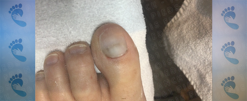 une reconstruction de l'ongle en gel-uv GEWHOL parfaitement réussie