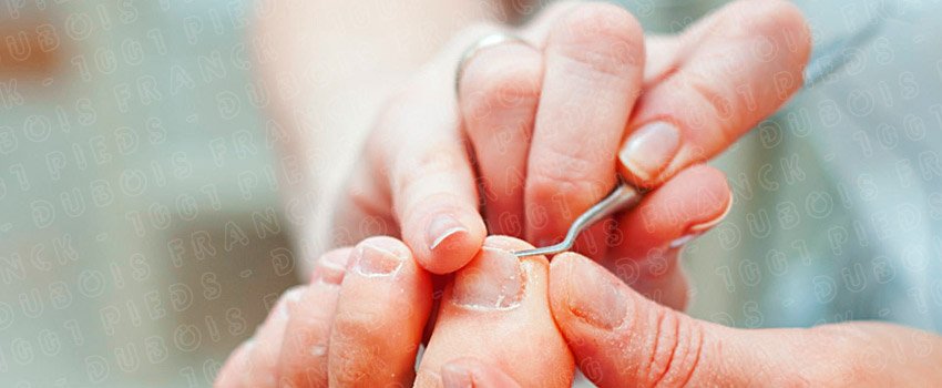 Traitement des ongles incarnés, soins podologique de 1001pieds ™ Franck Dubois Val Morin