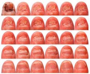 ongle mycose évolution et traitement de soins