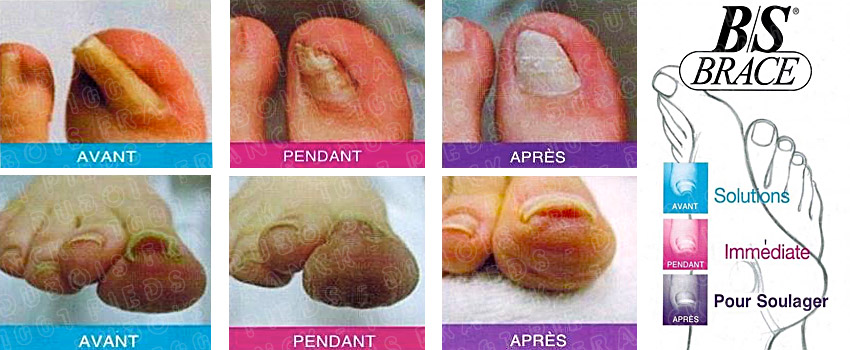 reconstruction de l'ongle avec le procédé BS Brace